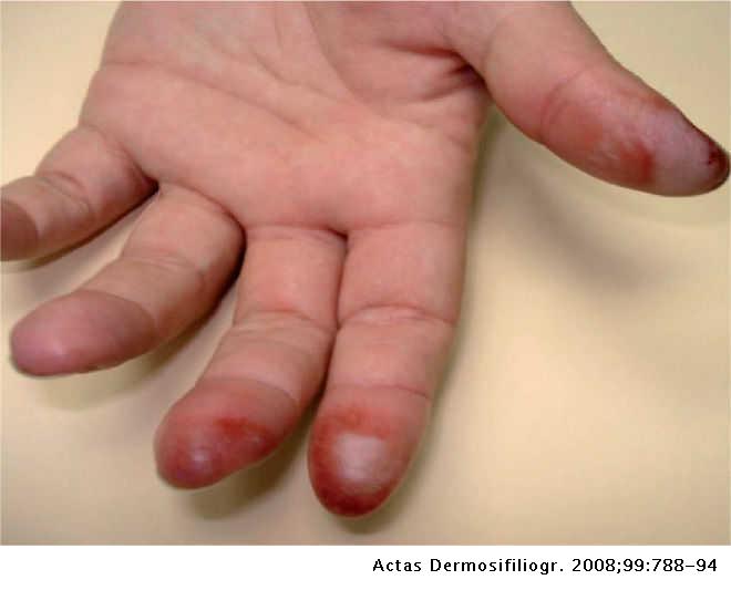 Sensibilización a acrilatos por uñas artificiales acrílicas. Revisión de 15  casos | Actas Dermo-Sifiliográficas