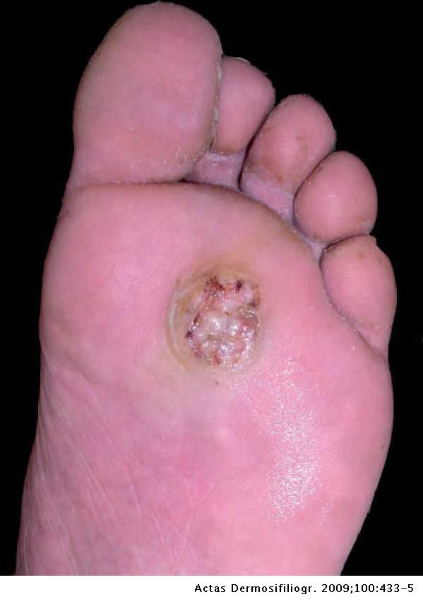 Virus papiloma pie, Que es el papiloma del pie