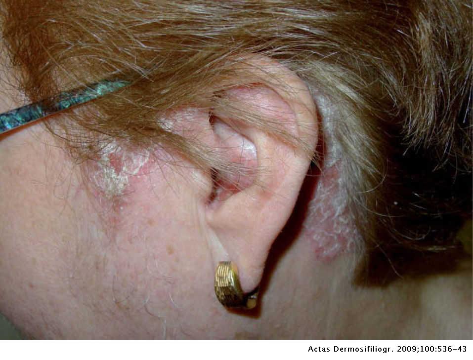 Ambicioso Por el contrario Para construir Psoriasis del cuero cabelludo | Actas Dermo-Sifiliográficas