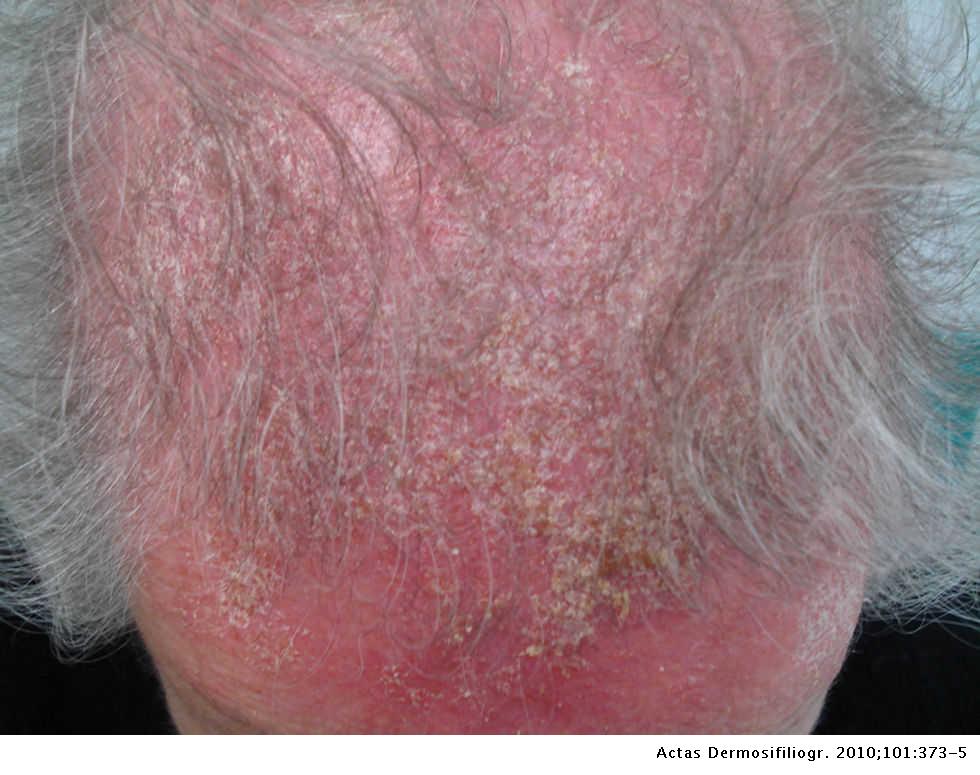 Abreviatura hipótesis puesta de sol Dermatitis alérgica de contacto a quinina por una loción capilar anticaída  | Actas Dermo-Sifiliográficas