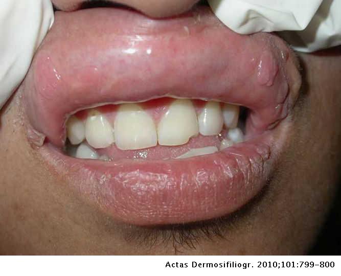 Papiloma en los labios dela boca tratamiento - Papiloma en labios boca - Papiloma en labios boca