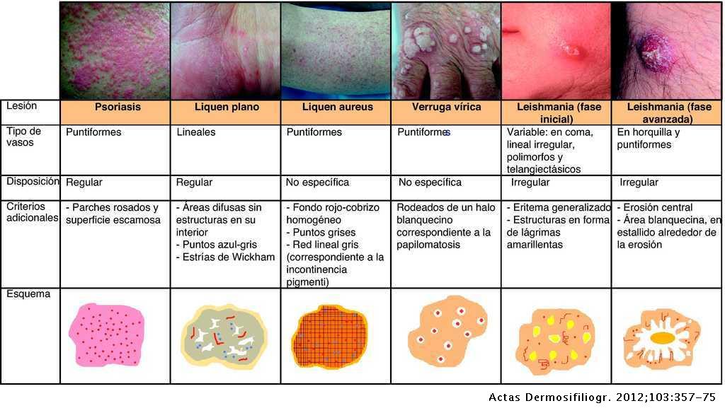 segmental vene intradermice varicoase