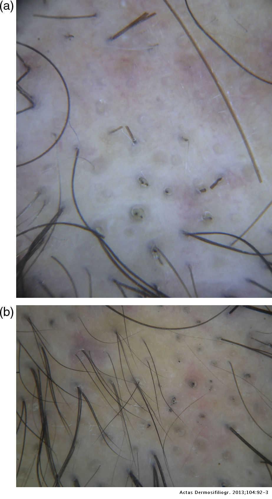 Dermoscopy of Early Dissecting Cellulitis of the Scalp Simulates Alopecia  Areata | Actas Dermo-Sifiliográficas