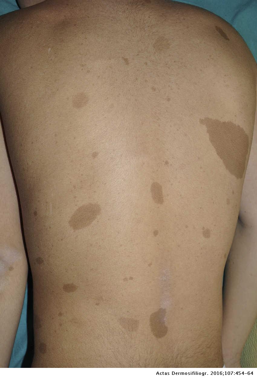 Neurofibromatosis Tipo 1 Mas Que Manchas Cafe Con Leche Efelides Y Neurofibromas Parte I Actualizacion Sobre Los Criterios Dermatologicos Diagnosticos De La Enfermedad Actas Dermo Sifiliograficas Neurofibromatosis Tipo 1 Mas Que Manchas Cafe Con Leche Efelides Y Neurofibromas Parte I Actualizacion Sobre Los Criterios Dermatologicos Diagnosticos De La Enfermedad Actas Dermo Sifiliograficas