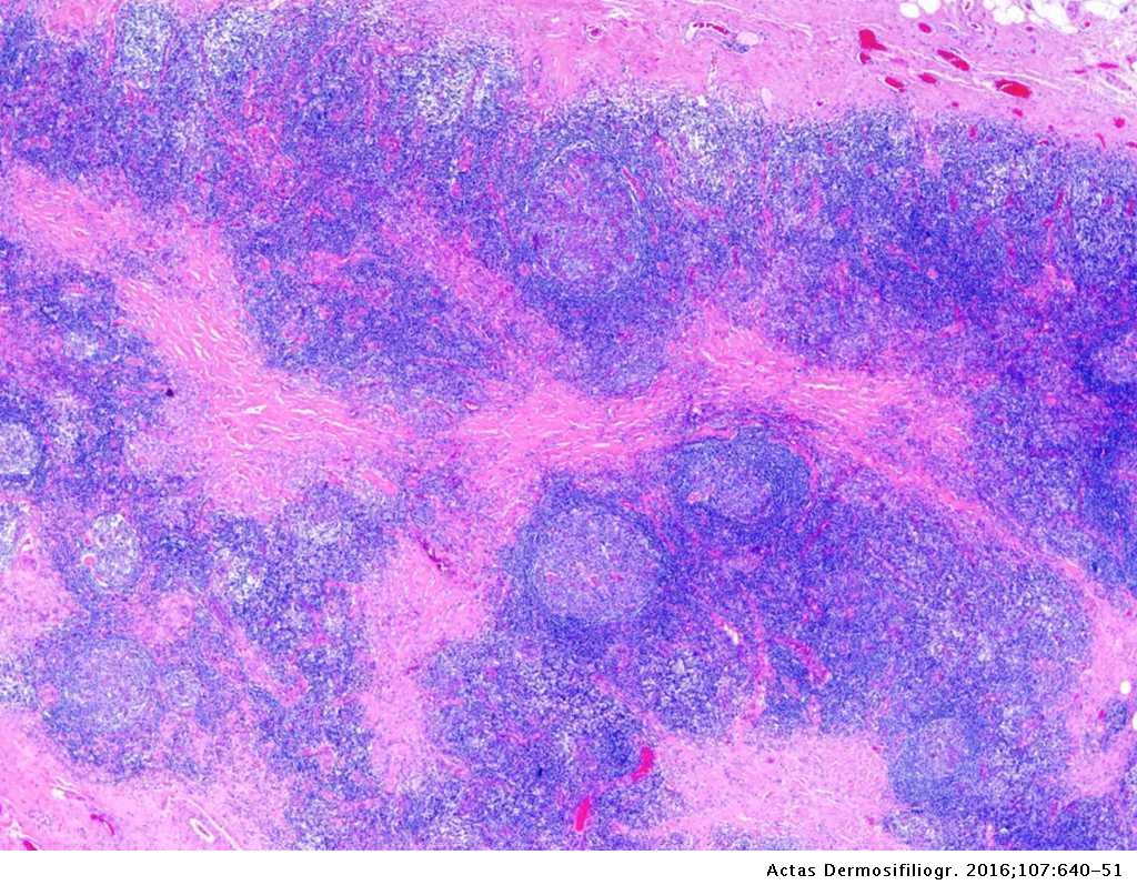 Pseudolinfomas cutáneos | Actas Dermo-Sifiliográficas Pseudolinfomas cutáneos | Actas Dermo-Sifiliográficas