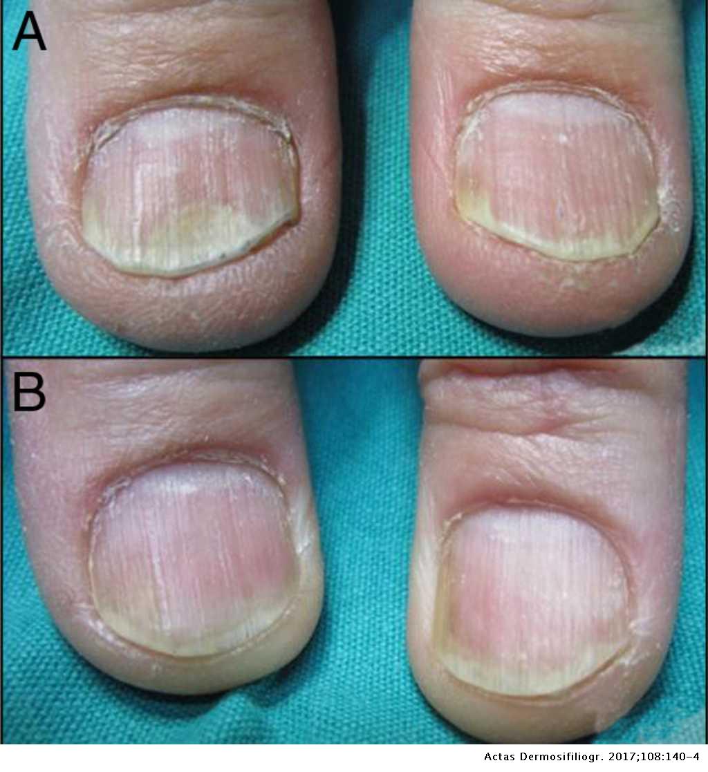 nail psoriasis, topical treatment