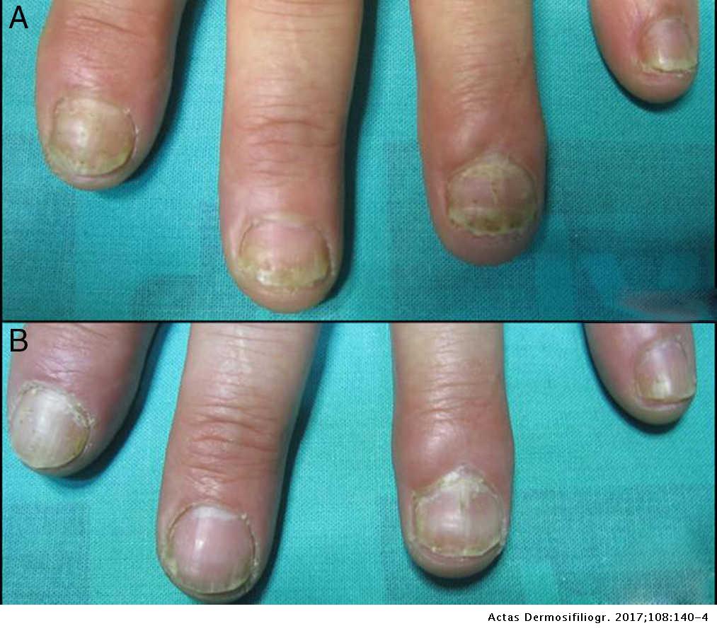 gel nails and psoriasis