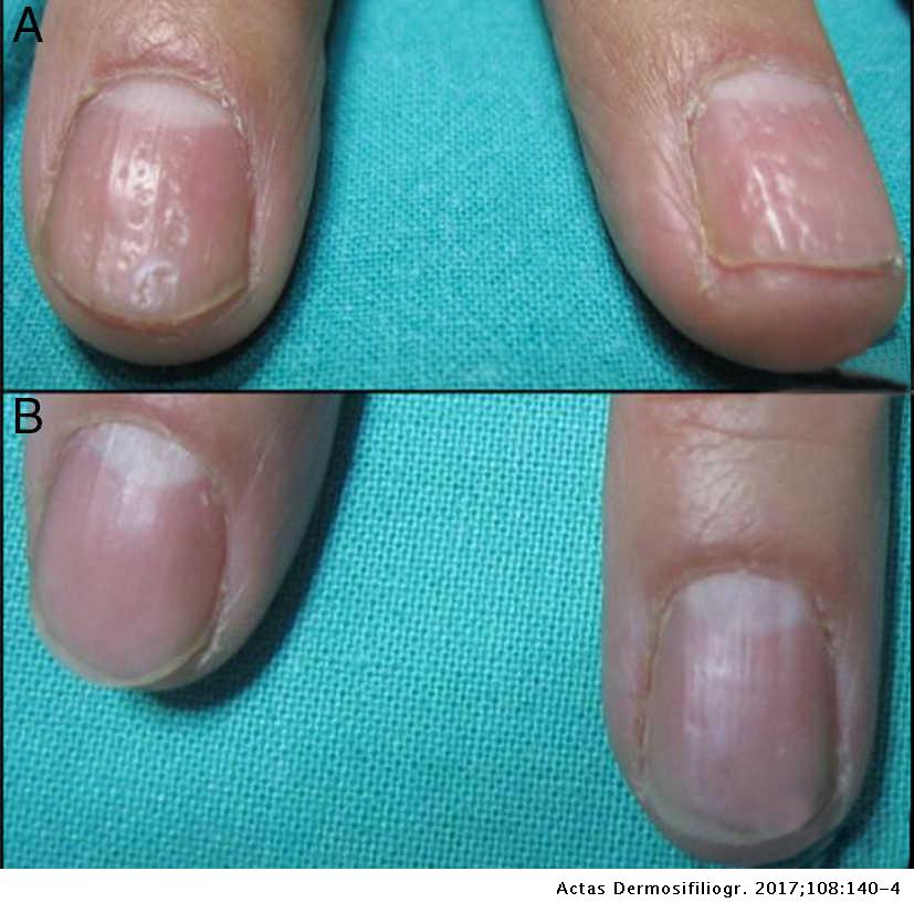 psoriasis nail changes)