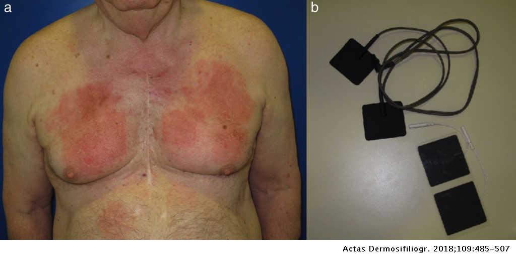Rectángulo Adjuntar a Montón de Dermatitis de contacto alérgica por regiones anatómicas. Claves  diagnósticas | Actas Dermo-Sifiliográficas