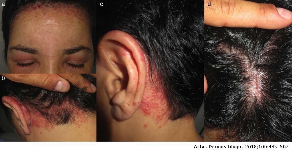 Cambiable Galleta Minero Dermatitis de contacto alérgica por regiones anatómicas. Claves  diagnósticas | Actas Dermo-Sifiliográficas