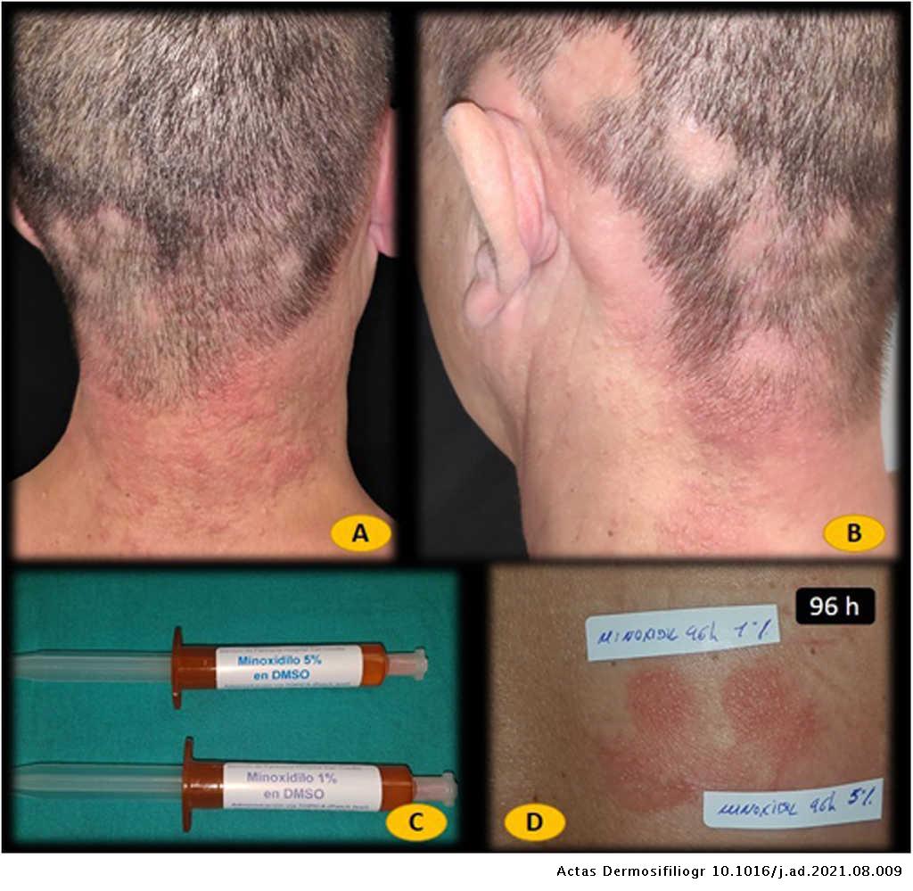 embudo Paisaje favorito Dermatitis alérgica de contacto por minoxidil en paciente con alopecia  areata | Actas Dermo-Sifiliográficas