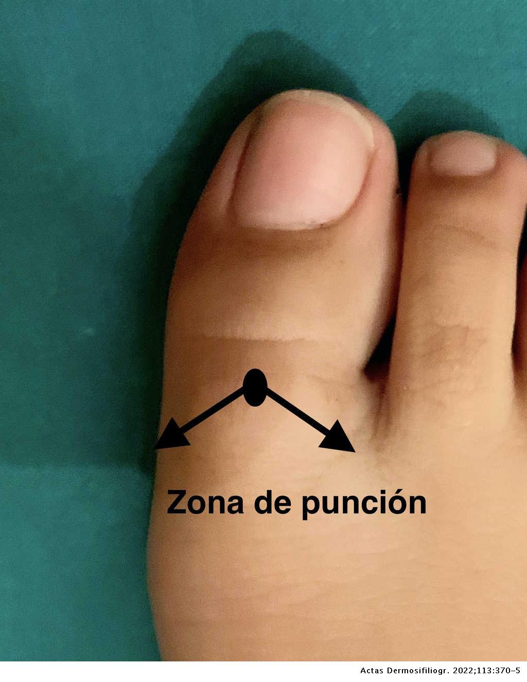 Comparación de 2 técnicas anestésico en el tratamiento de onicocriptosis del primer dedo del pie | Actas Dermo-Sifiliográficas