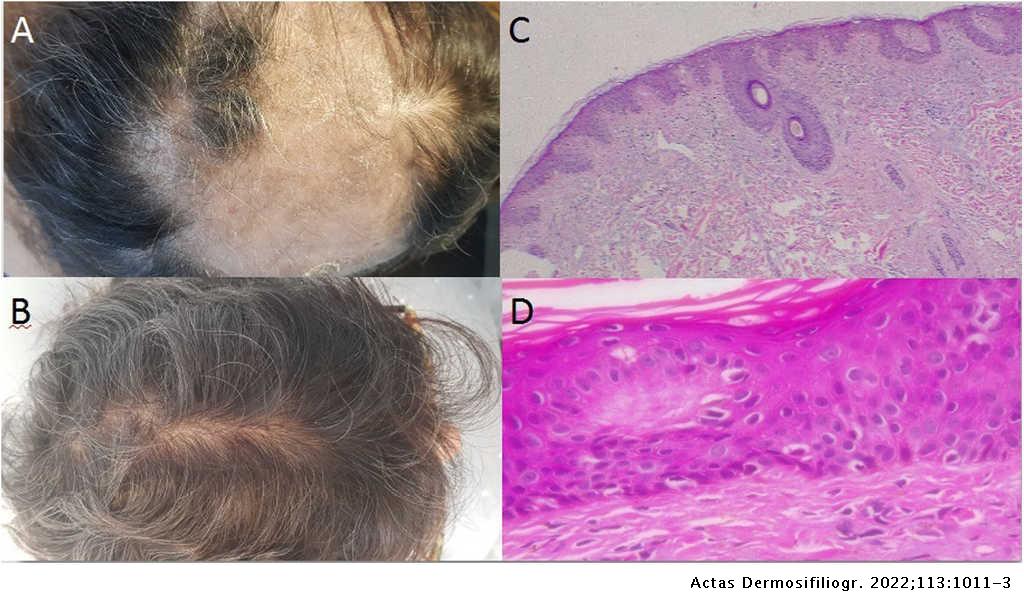 Nonscarring Alopecia Secondary to Secukinumab | Actas Dermo-Sifiliográficas Nonscarring Alopecia Secondary to Secukinumab | Actas Dermo-Sifiliográficas