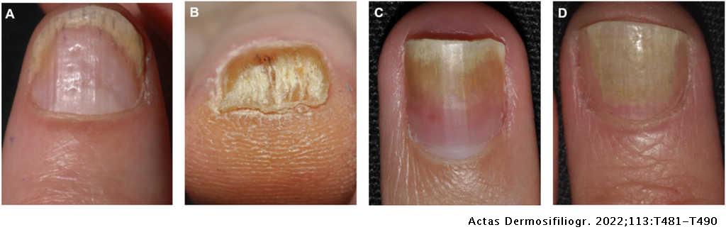 Translated article] Nail Psoriasis | Actas Dermo-Sifiliográficas