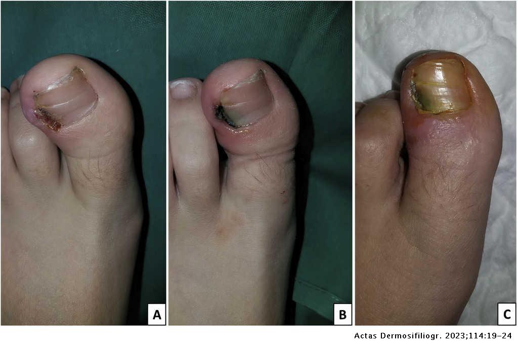 Matrix Cauterization With Silver Nitrate in the Treatment of Ingrown  Toenails in Children: Pilot Study | Actas Dermo-Sifiliográficas
