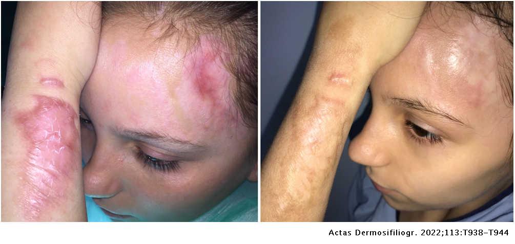 Grit Koningin Ontvangende machine Translated article] Laser Treatment of Burn Scars | Actas  Dermo-Sifiliográficas