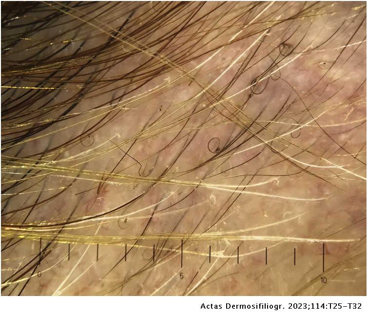 Translated article] Trichoscopy in Alopecia Areata | Actas  Dermo-Sifiliográficas