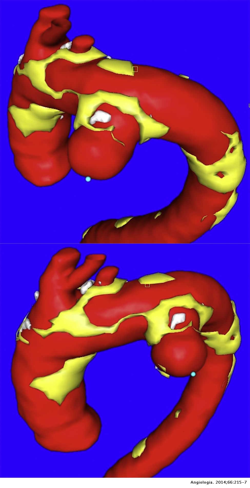 La morfología del aneurisma importa: sacular versus fusiforme | Angiología