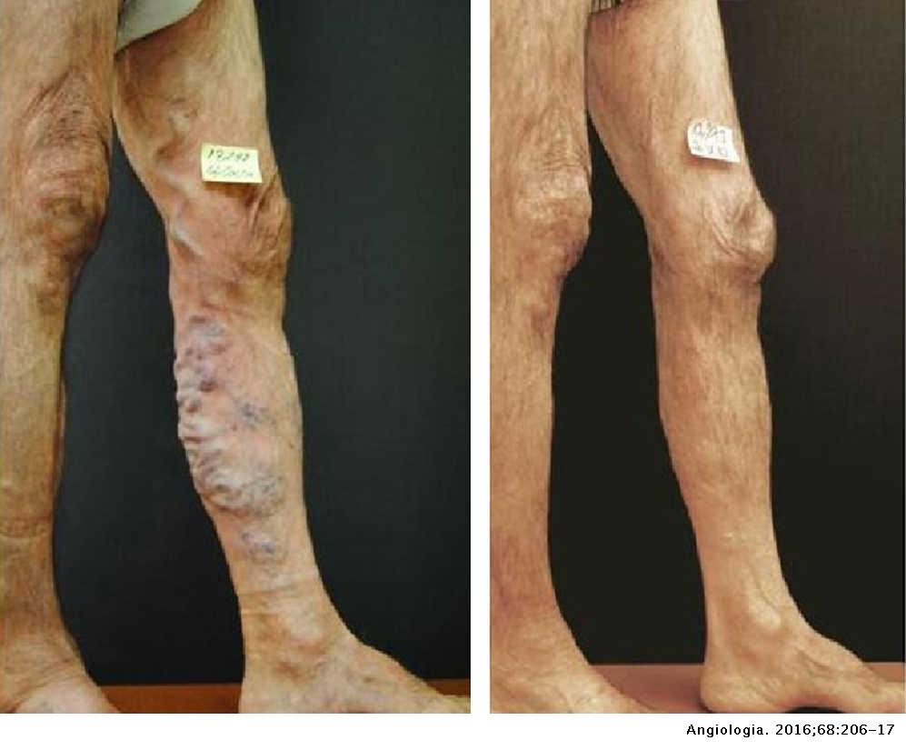 Ce să faci dacă cu varice se extind și piciorul se întărește și doare