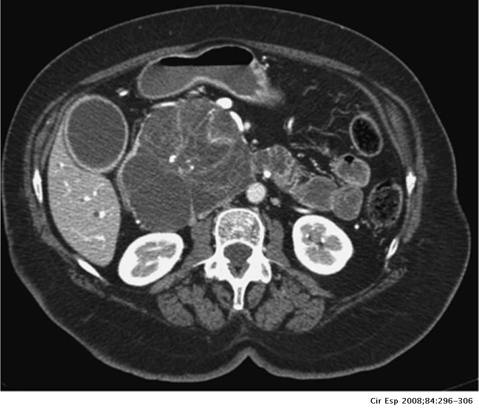 Neoplasias quísticas del páncreas. Manejo diagnóstico y terapéutico