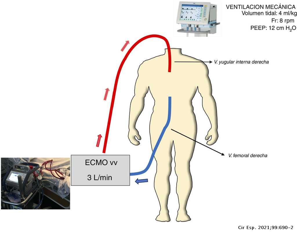 Hipoxemia refractaria en la enfermedad traumática grave. Utilidad de la ECMO venovenosa Hipoxemia refractaria en la enfermedad traumática grave. Utilidad de la ECMO venovenosa