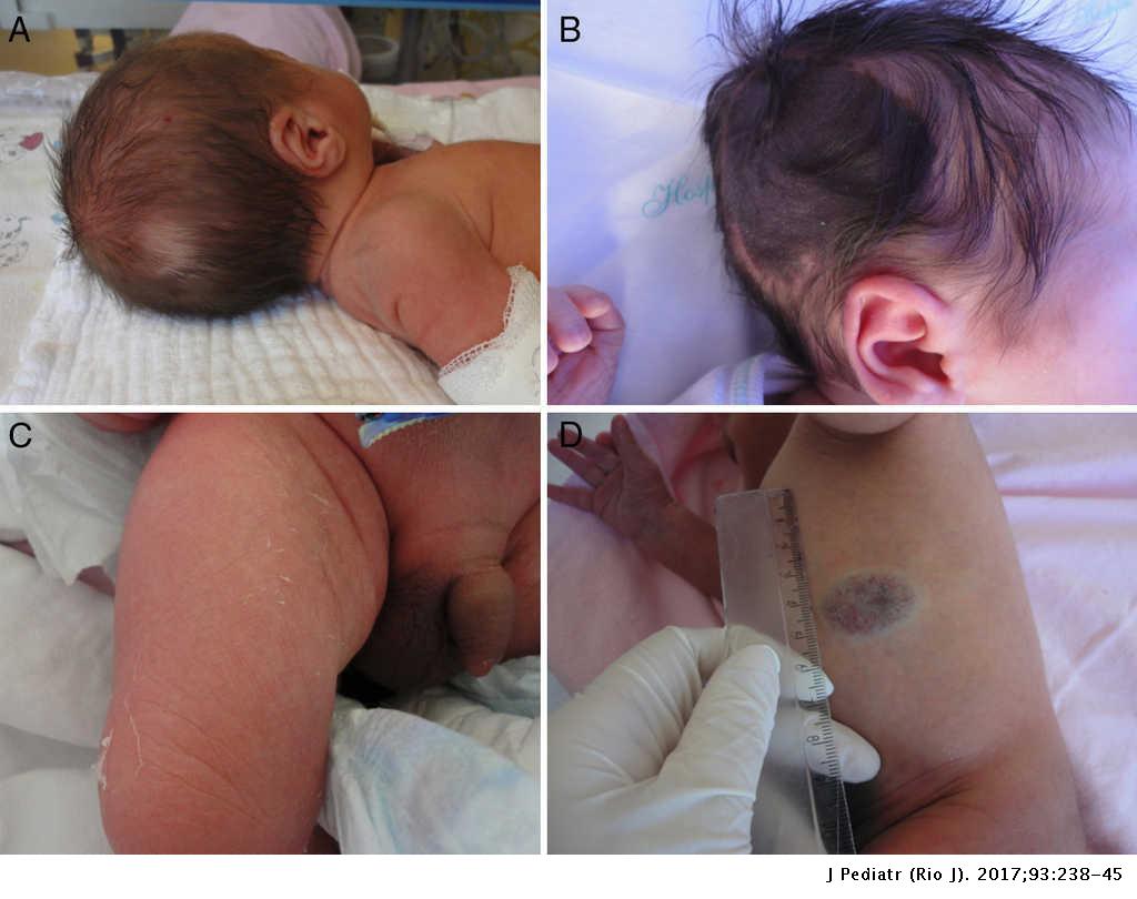 Prevalence And Characterization Of Neonatal Skin Disorders In The