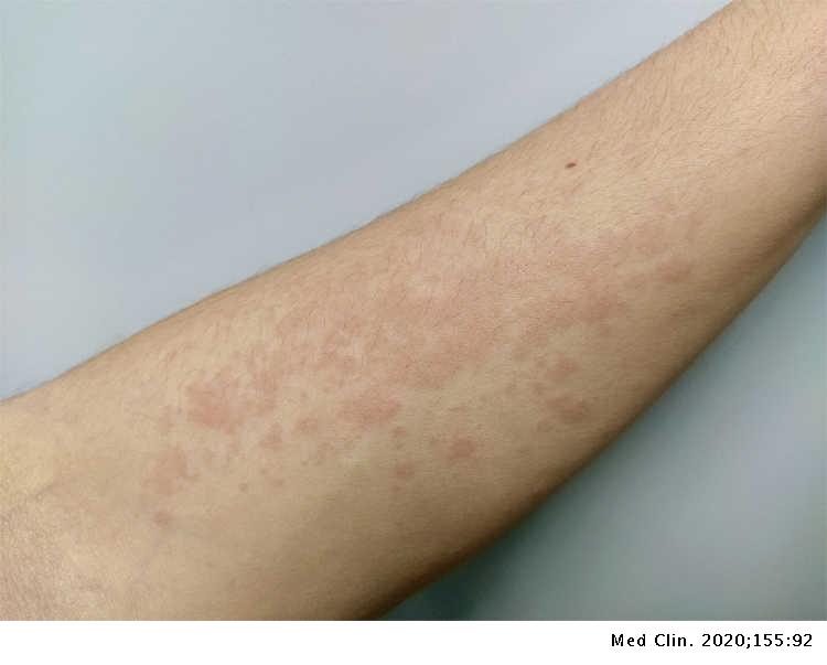 Rash maculopapuloso como manifestación inicial de infección por SARS ...