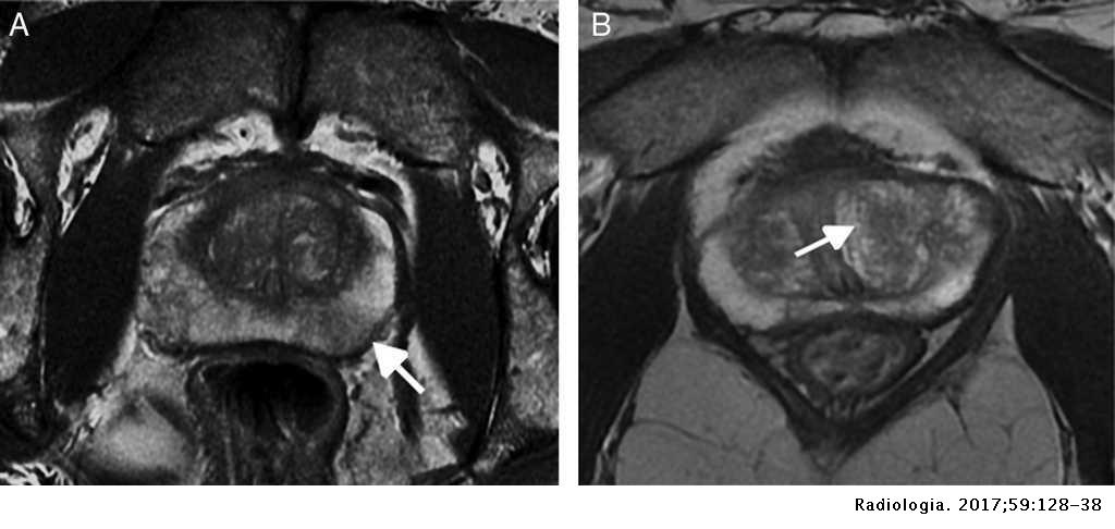 Resonancia magnética de próstata: lectura con el sistema PI-RADS V2 ...