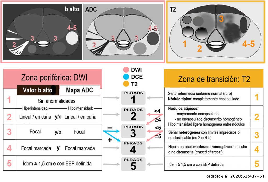 Resonancia magnética de próstata: guía práctica de interpretación e ...