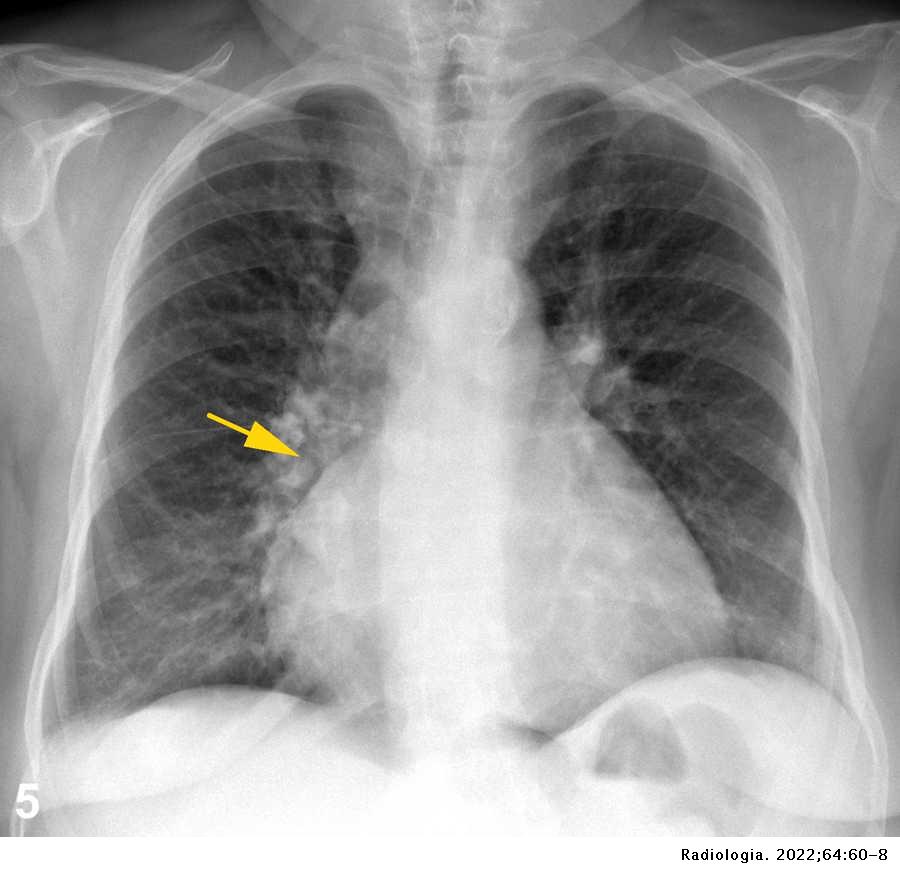 El hilio pulmonar, dos signos radiológicos clásicos para descifrarlo