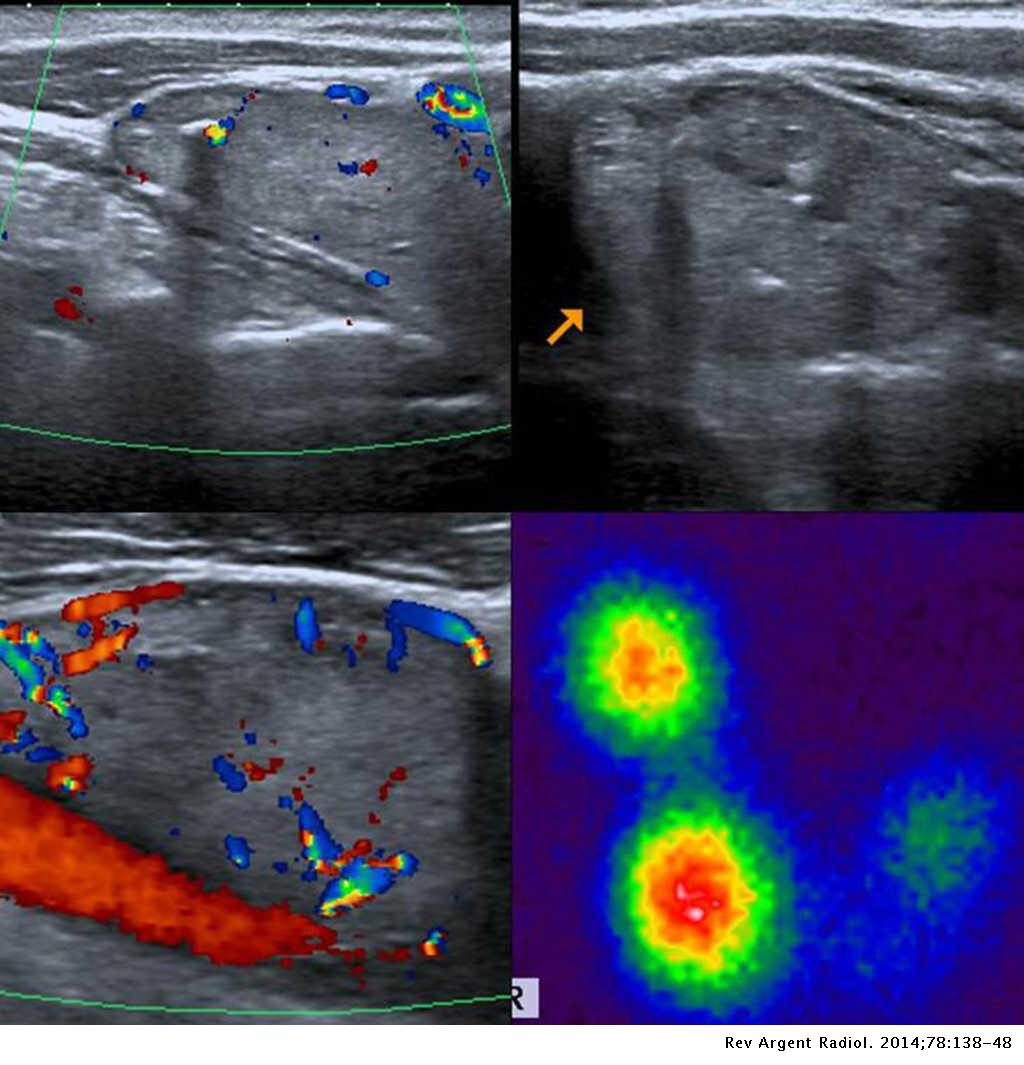 Clasificación TI-RADS de los nódulos tiroideos en base a una escala de ...