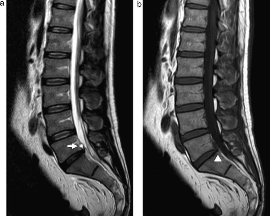 Quiste discal de columna lumbar. Hallazgos en resonancia magnética