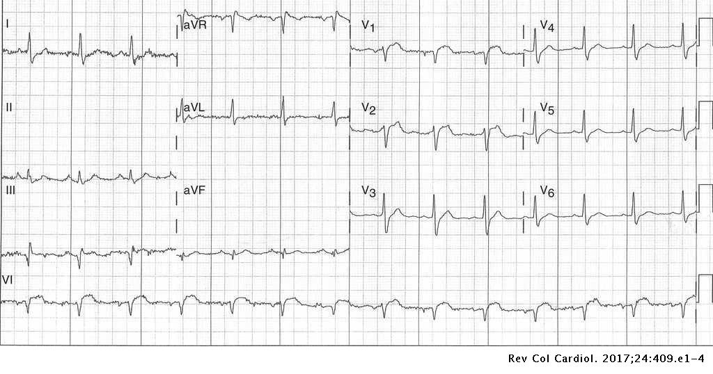 Infarto Agudo Miocardico Embolico Asociado A Embolia Pulmonar Revista Colombiana De Cardiologia Infarto Agudo Miocardico Embolico Asociado A Embolia Pulmonar Revista Colombiana De Cardiologia