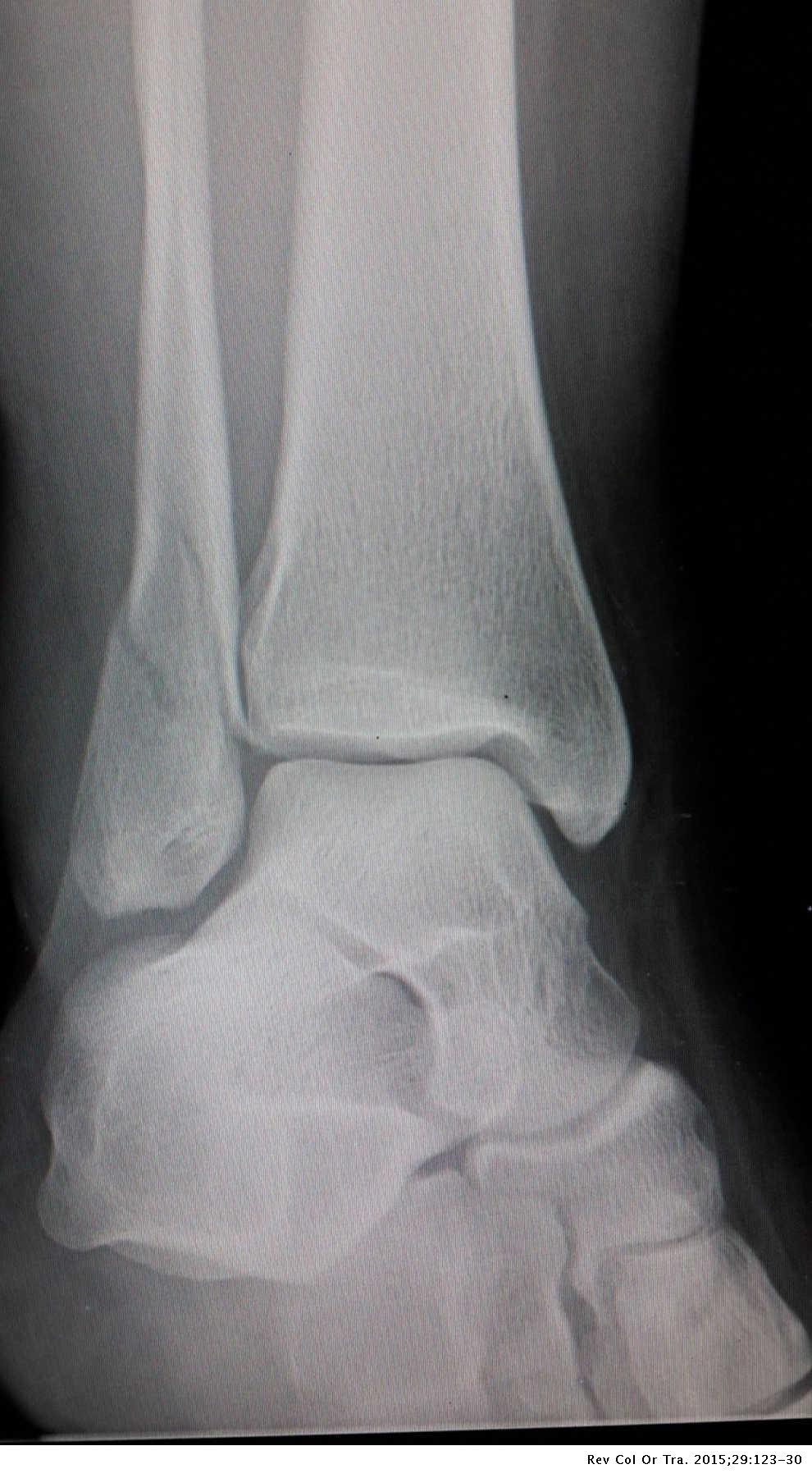 Impacto de la rehabilitación tras osteosíntesis con placa antideslizante en pacientes con fracturas de tobillo de tipo B de Weber | Revista Colombiana Ortopedia y Traumatología