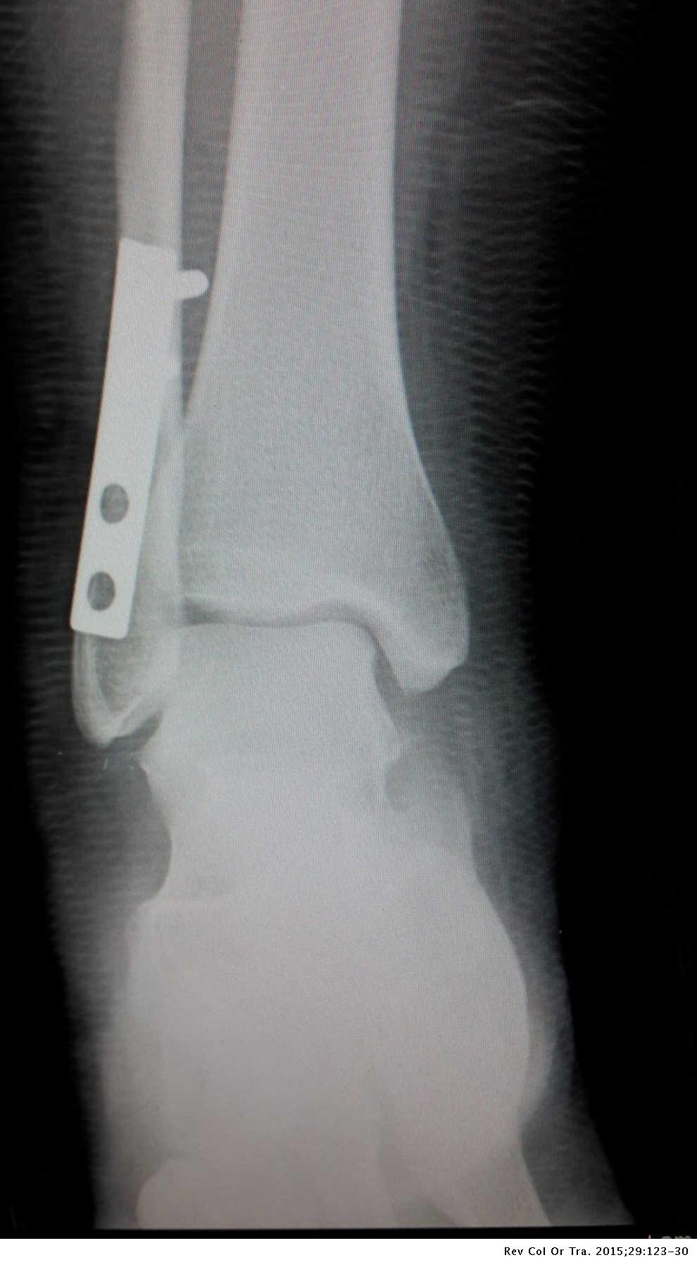 Impacto de la rehabilitación tras osteosíntesis con placa antideslizante en pacientes con fracturas de tobillo de tipo B de Weber | Revista Colombiana Ortopedia y Traumatología