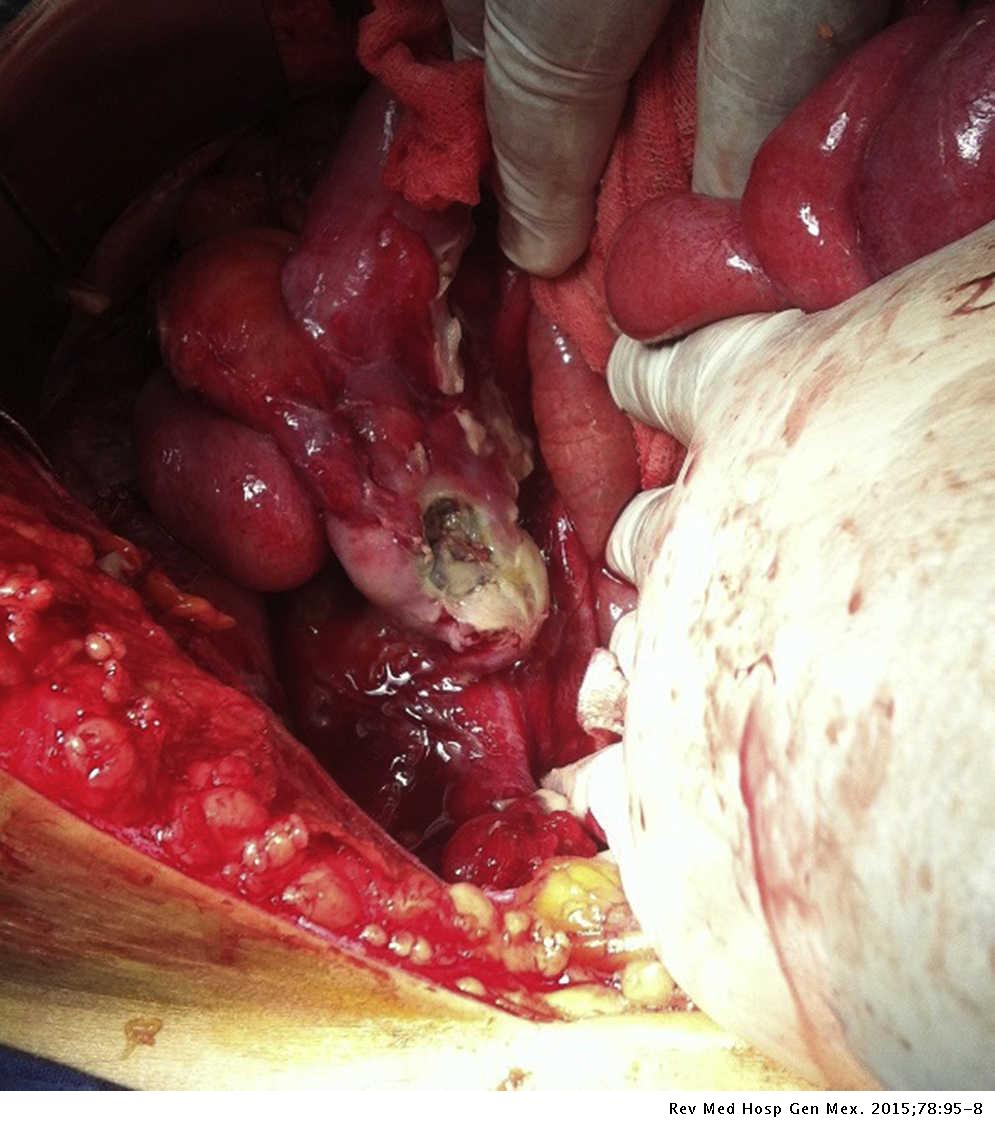 Ovarian cyst or appendicitis