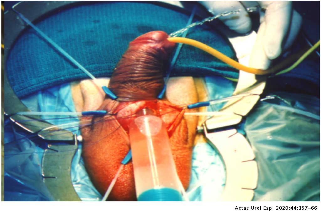 Complicaciones intraoperatorias y postoperatorias de la cirugía de prótesis  de pene. Diagnóstico y tratamiento | Actas Urológicas Españolas