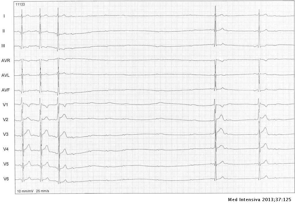 Adenosina y proarritmia en pacientes con síndrome de WolfParkinson