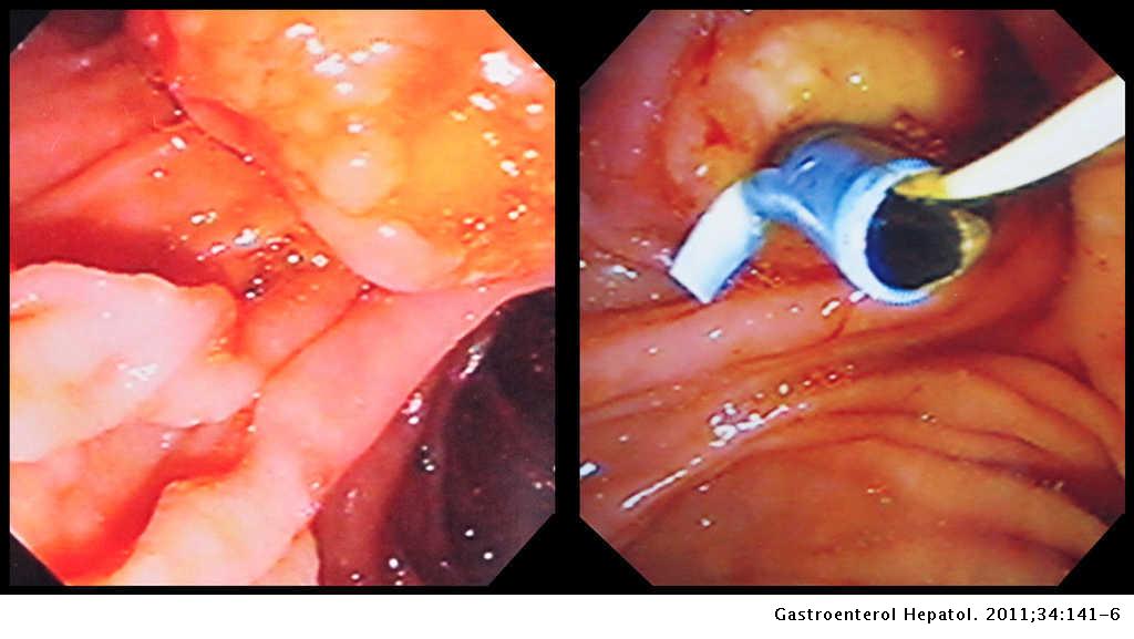 paciente Uluru debajo Carcinoma de células en anillo de sello de la ampolla de Vater |  Gastroenterología y Hepatología