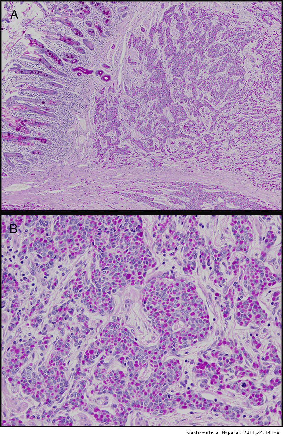paciente Uluru debajo Carcinoma de células en anillo de sello de la ampolla de Vater |  Gastroenterología y Hepatología