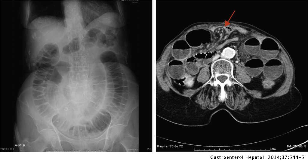 Vólvulo de intestino delgado: un diagnóstico radiológico en adultos | y Hepatología