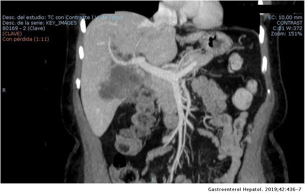Carcinoma primario de células escamosas del conducto hepático común a Carcinoma primario de células escamosas del conducto hepático común a