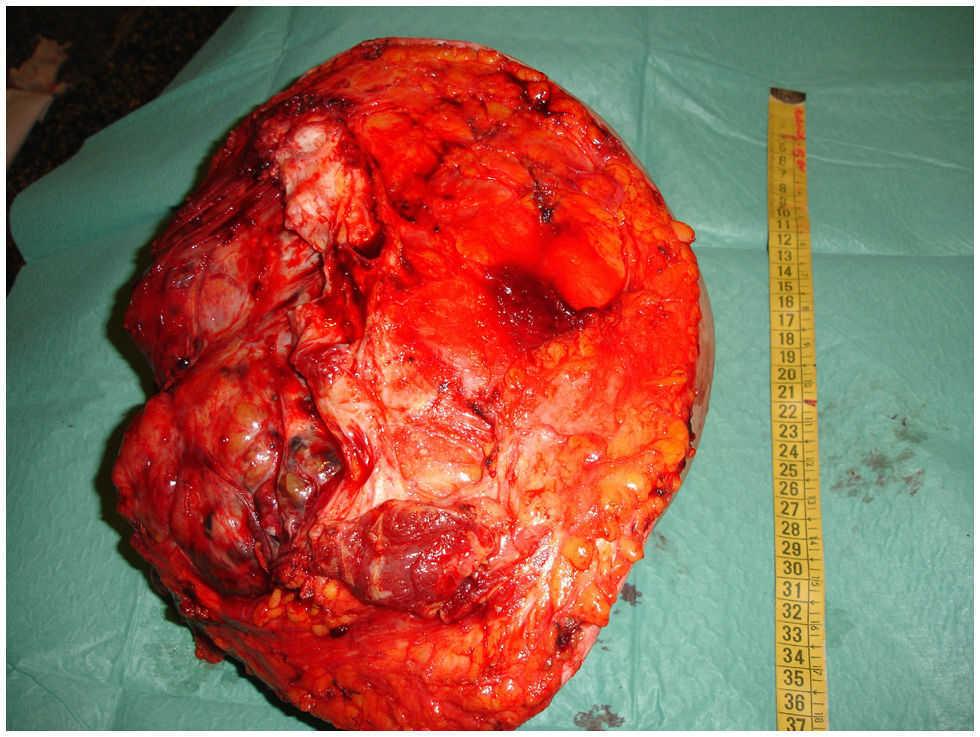 Tumor phyllodes de mama | Clínica e Investigación en Ginecología y