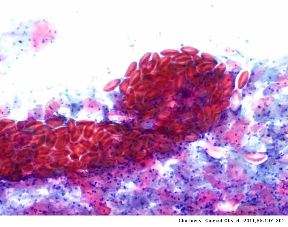 Enterobius vermicularis caso clinico - Papilloma squamoso nasale