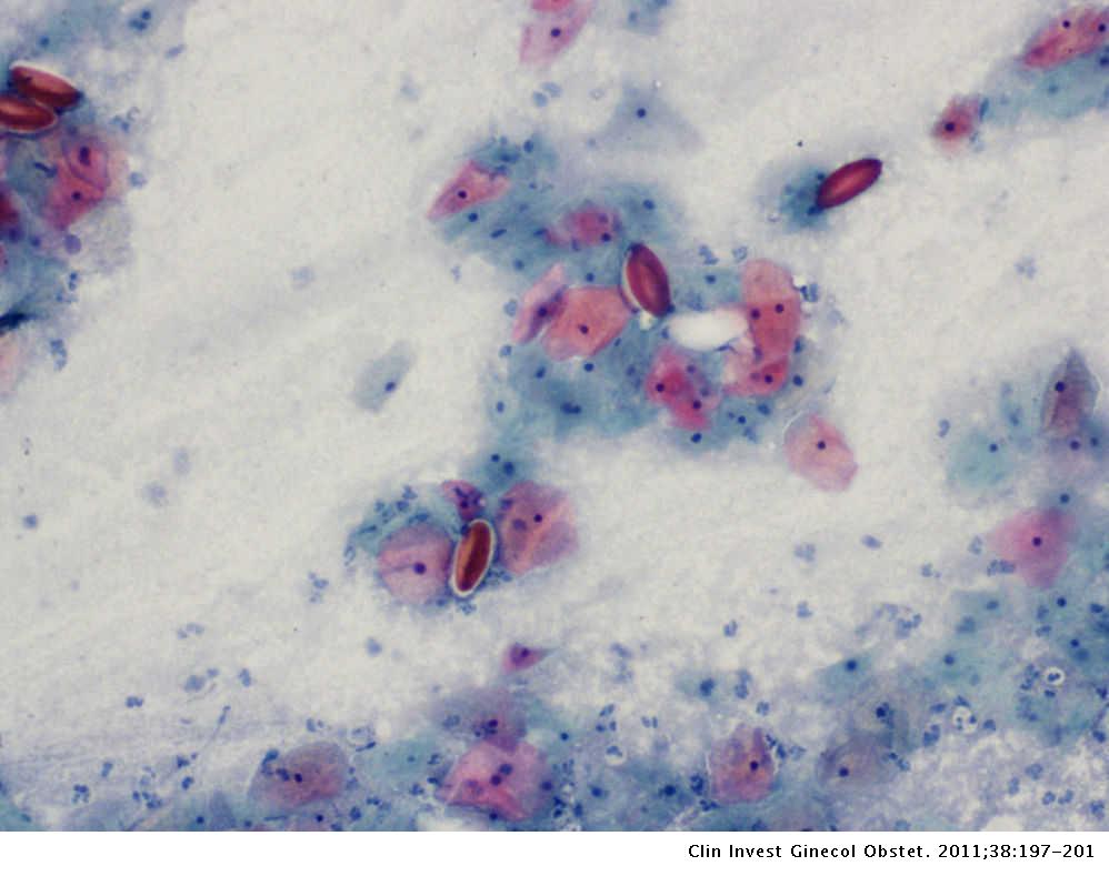 oxiuros e infeccion urinaria