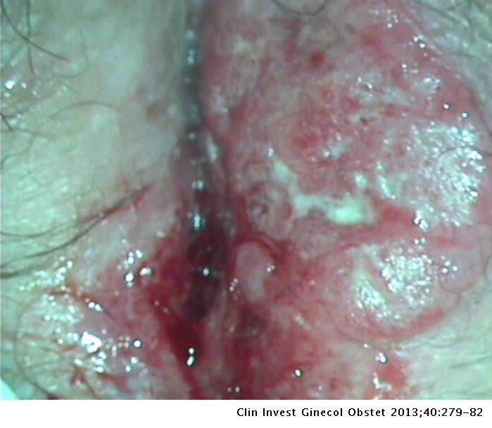 vulva la Carcinoma de epidermoid