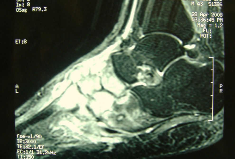 Osteomielitis crónica del pie | Enfermedades Infecciosas y