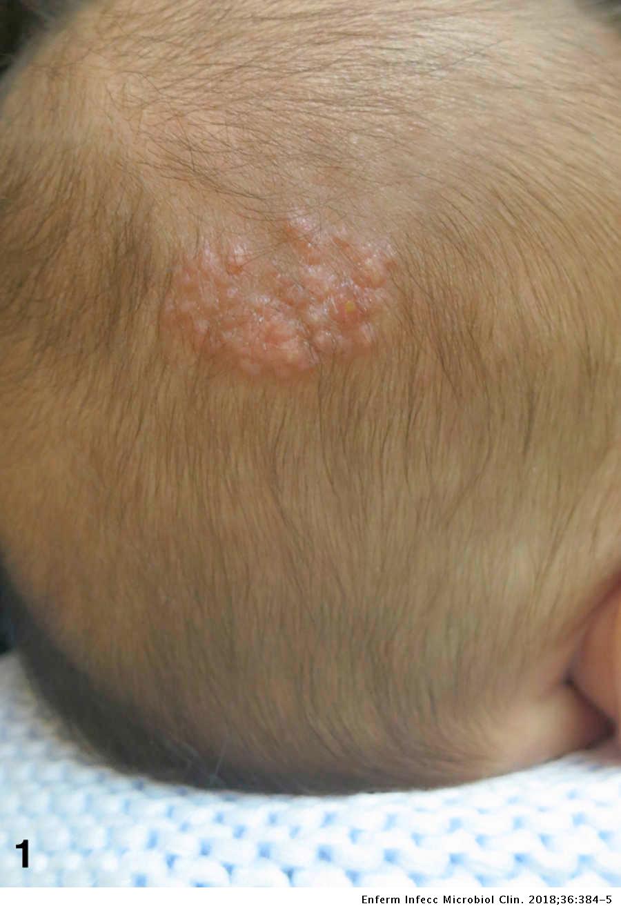 Placa verrugosa crecimiento progresivo en cuero cabelludo de lactante de 3 meses Enfermedades y Clínica