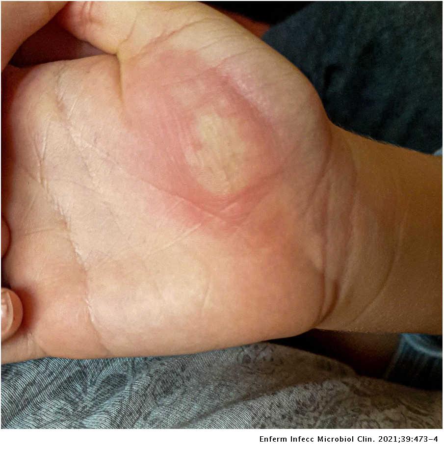 Lesión recurrente palmar | Enfermedades Infecciosas y Microbiología Clínica Lesión recurrente palmar | Enfermedades Infecciosas y Microbiología Clínica