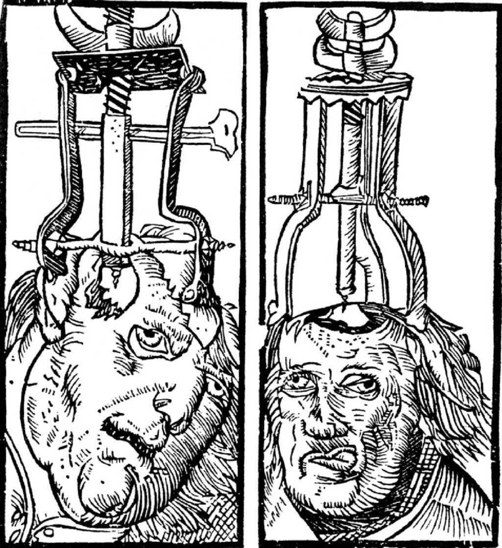 Imagen de dos individuos a los que se les está realizando una trepanación con instrumentos especializados que tienen colocados instrumentos de trefinado